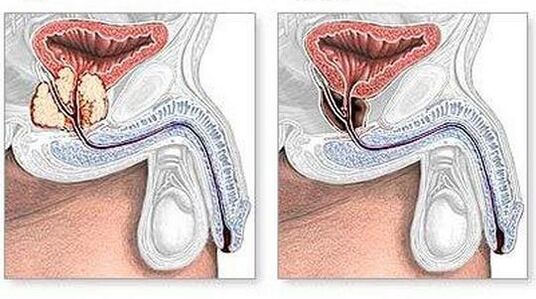 Voor en na de behandeling van chronische prostatitis chirurgisch