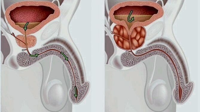 gezonde en ontstoken prostaat met prostatitis