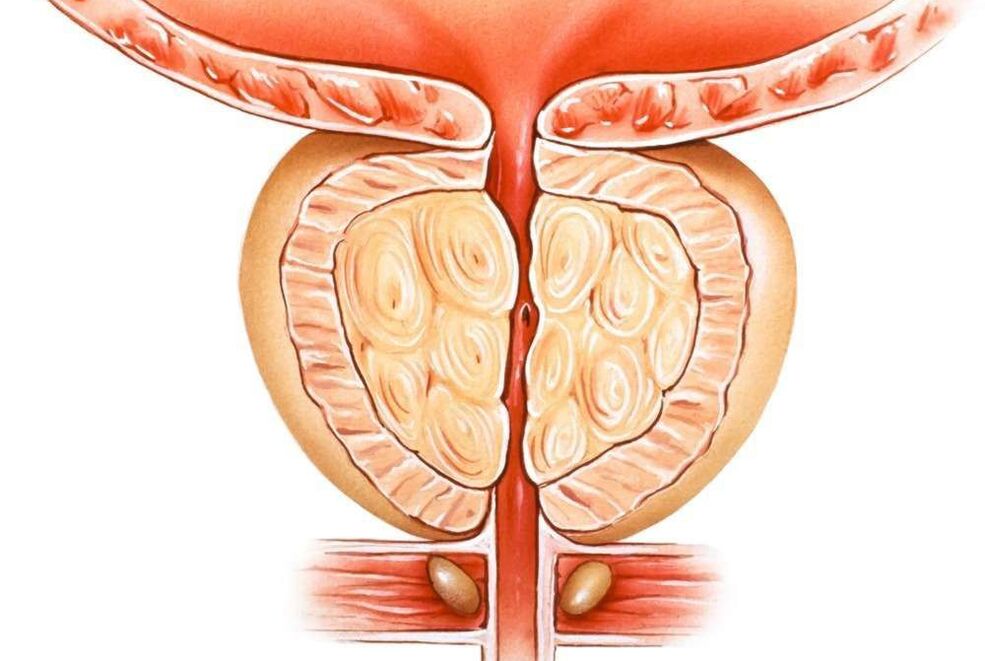 congestieve prostatitis