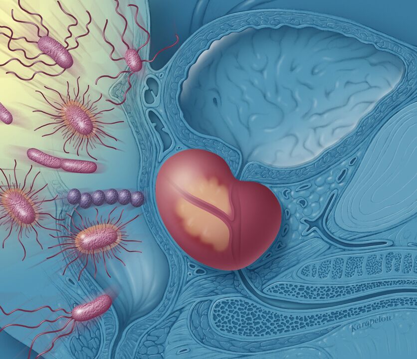 Prostatitis bij mannen