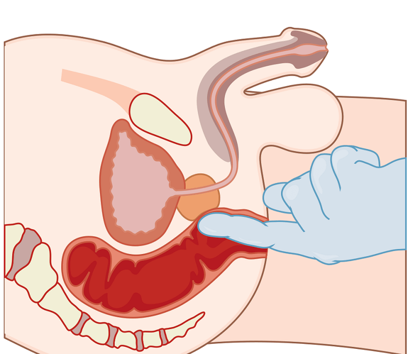prostaatmassage met prostatitis