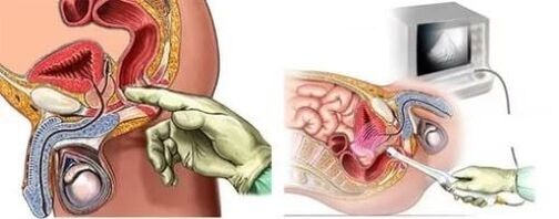 Instrumentele diagnose van prostatitis