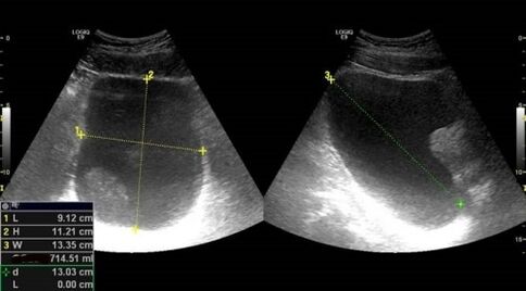 Tekenen van prostatitis voor echografie